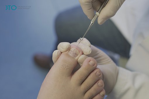 ingrown toenail podiatrist 